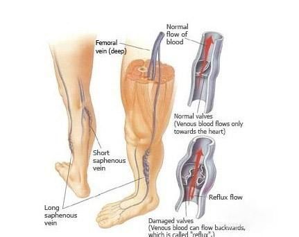 下肢静脉炎症状表现(下肢静脉炎吃什么药好得快)-第1张图片-