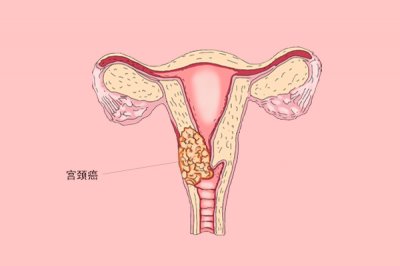 ​什么是宫颈肥大如何恢复正常（检查出宫颈肥大是怎么一回事？需不需要治疗，高